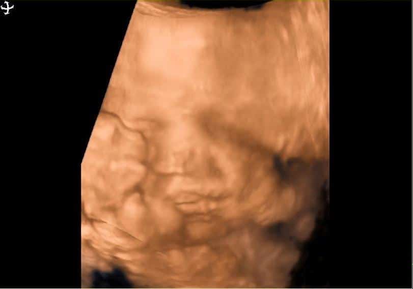34 week ultrasound